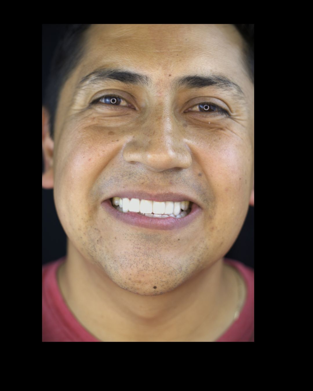 Diseño de sonrisa