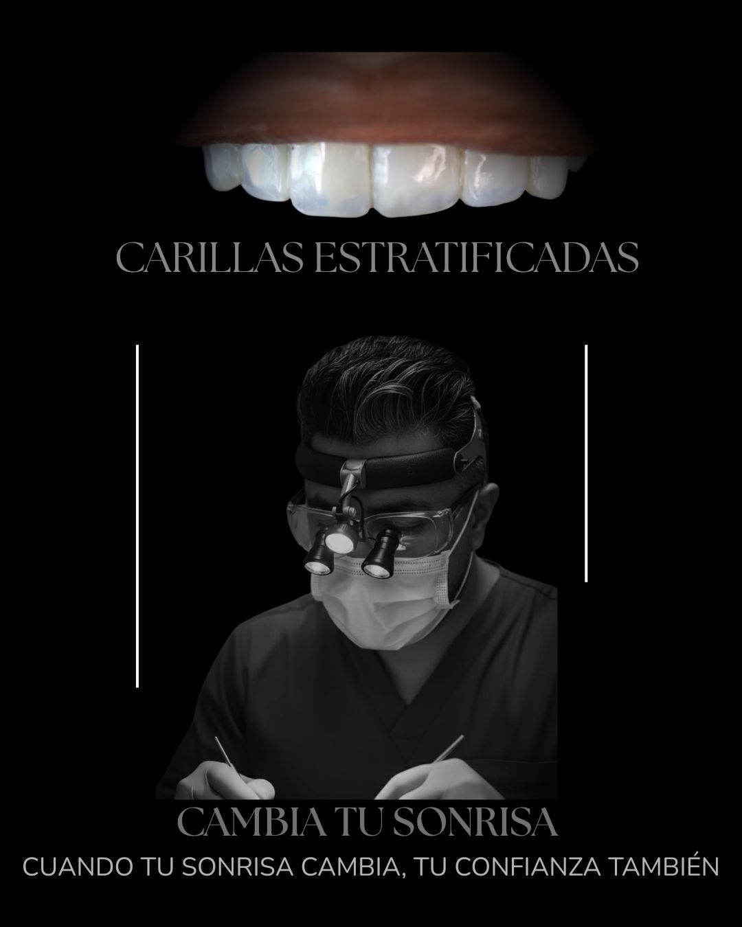 Carillas estratificadas y diseño de sonrisa