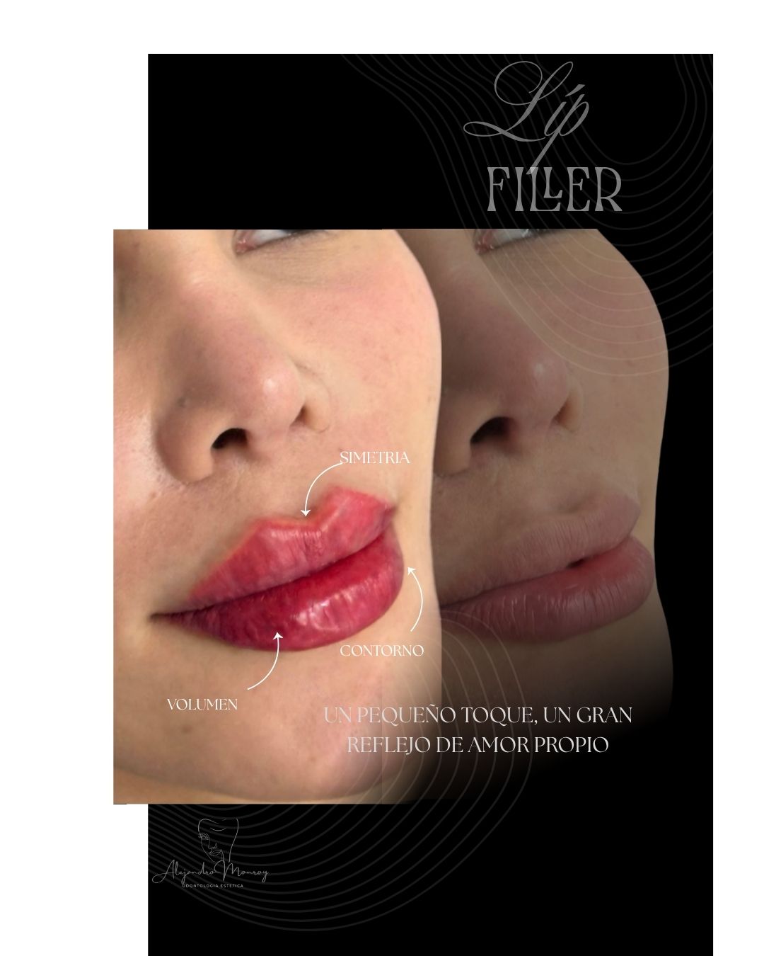 Relleno y aumento de labios
