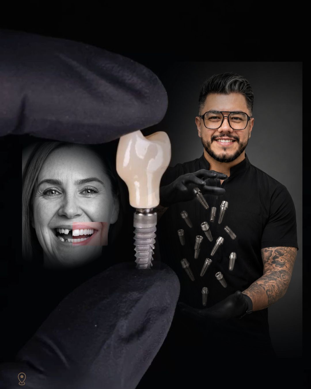 Implantes dentales